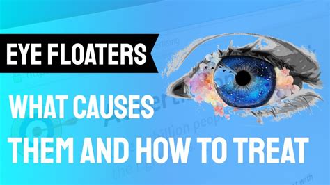 What Causes Floaters After Cataract Surgery
